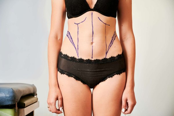 Abdominoplastie : les différents types de chirurgie possibles